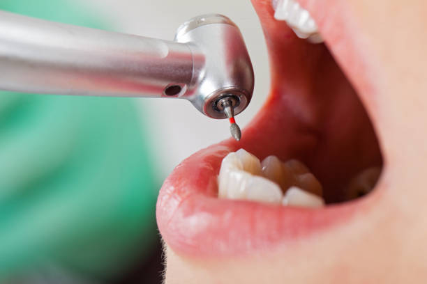 Best Emergency Tooth Extraction in Wolcott, IN